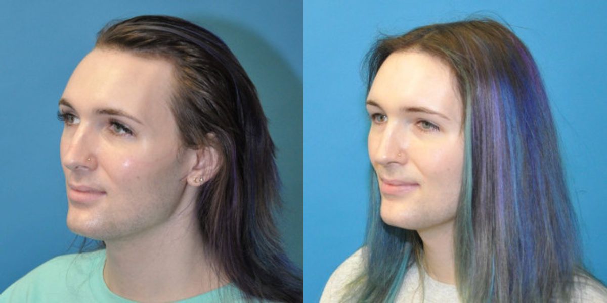 FUE NeoGraft Hair Transplant #11 - Before and After