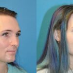 FUE NeoGraft Hair Transplant #11 - Before and After