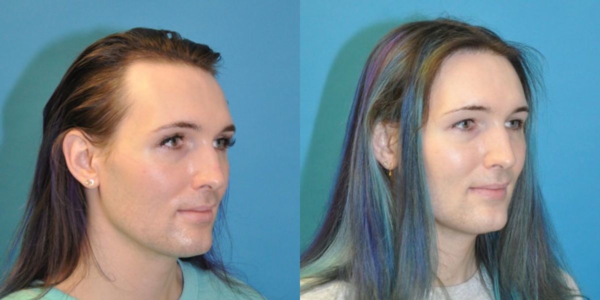 FUE NeoGraft Hair Transplant #11 - Before and After