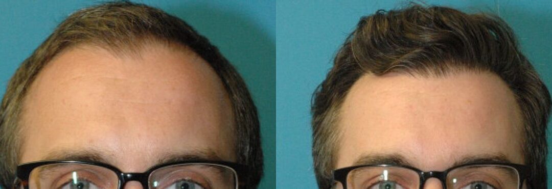 FUE NeoGraft Hair Transplant #12