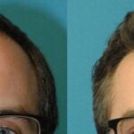 FUE NeoGraft Hair Transplant #12 - Before and After