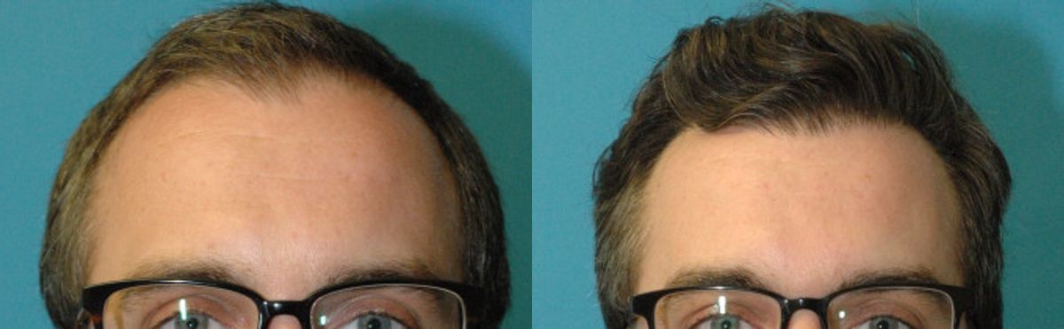 FUE NeoGraft Hair Transplant #12 - Before and After