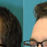 FUE NeoGraft Hair Transplant #12 - Before and After