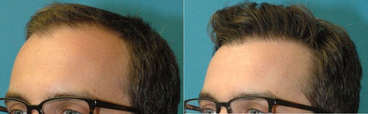 FUE NeoGraft Hair Transplant #12 - Before and After