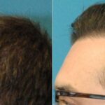 FUE NeoGraft Hair Transplant #12 - Before and After