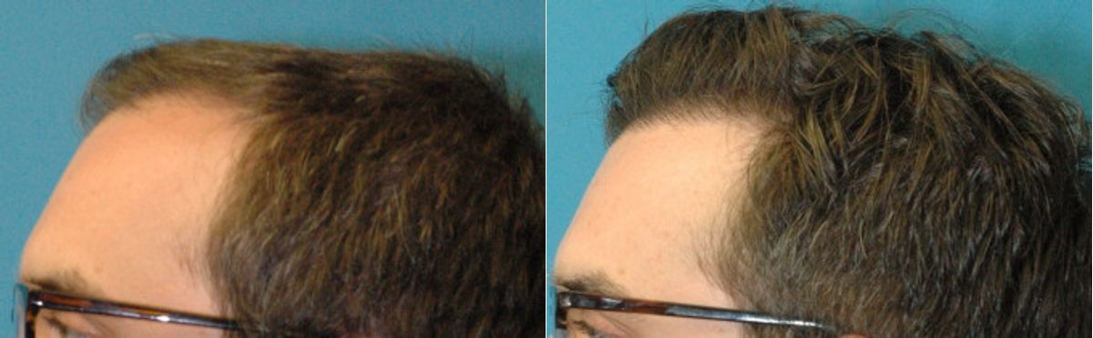FUE NeoGraft Hair Transplant #12 - Before and After