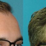 FUE NeoGraft Hair Transplant #12 - Before and After