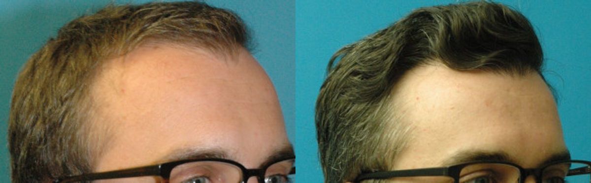 FUE NeoGraft Hair Transplant #12 - Before and After
