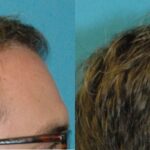 FUE NeoGraft Hair Transplant #12 - Before and After