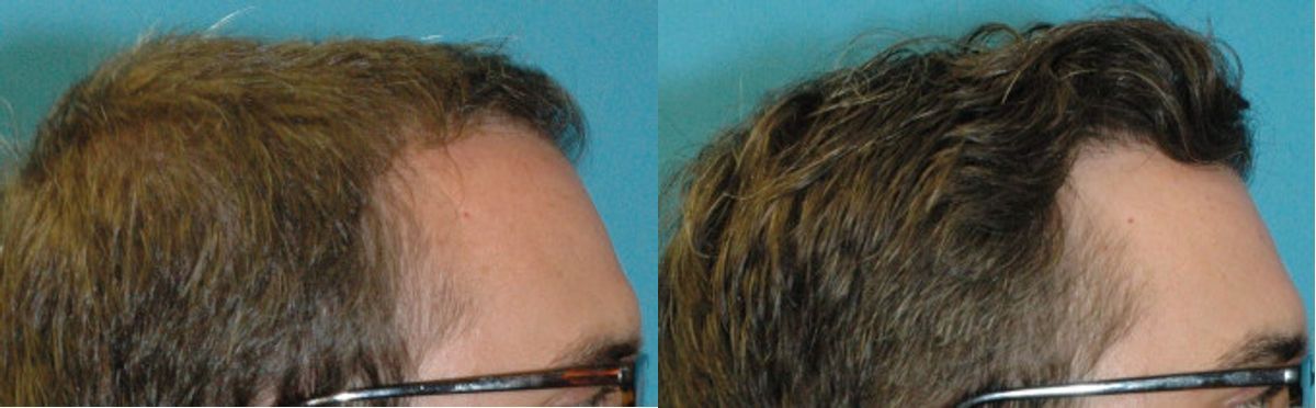 FUE NeoGraft Hair Transplant #12 - Before and After