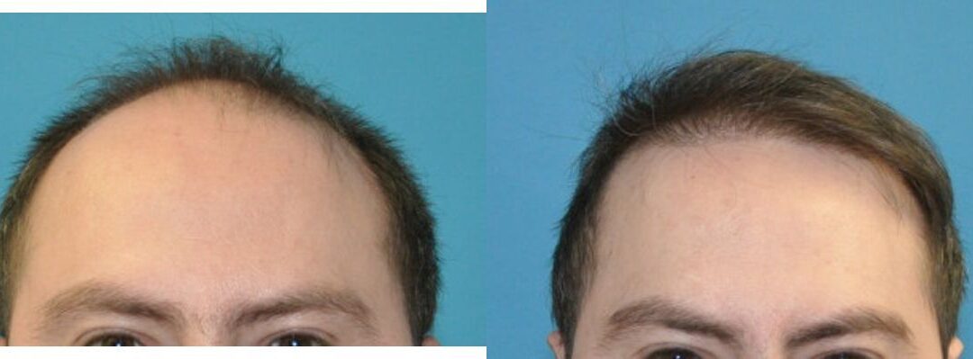 FUE NeoGraft Hair Transplant #13