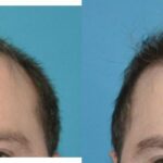 FUE NeoGraft Hair Transplant #13 - Before and After