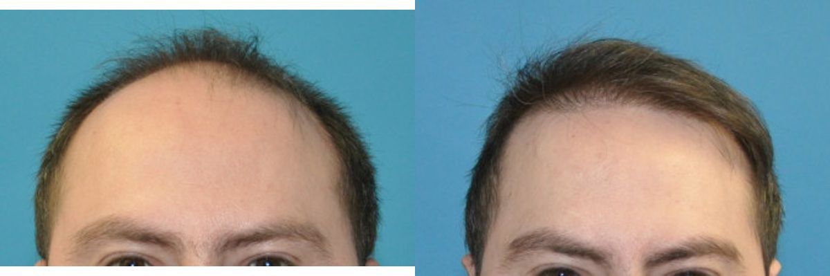 FUE NeoGraft Hair Transplant #13 - Before and After