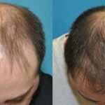 FUE NeoGraft Hair Transplant #13 - Before and After