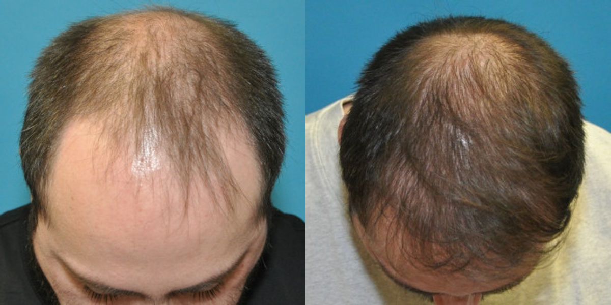 FUE NeoGraft Hair Transplant #13 - Before and After