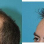 FUE NeoGraft Hair Transplant #13 - Before and After