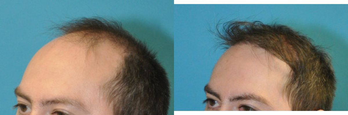 FUE NeoGraft Hair Transplant #13 - Before and After