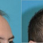 FUE NeoGraft Hair Transplant #13 - Before and After