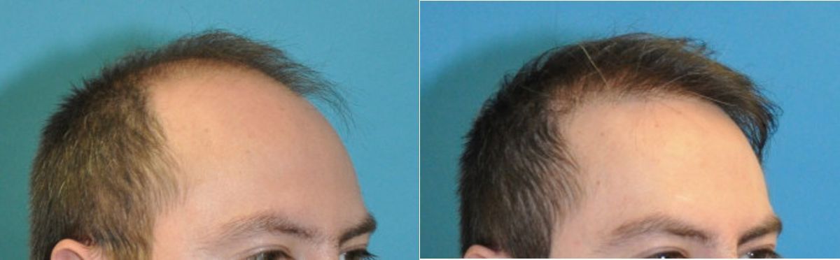 FUE NeoGraft Hair Transplant #13 - Before and After