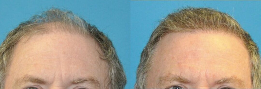 FUE NeoGraft Hair Transplant #14