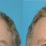 FUE NeoGraft Hair Transplant #14 - Before and After