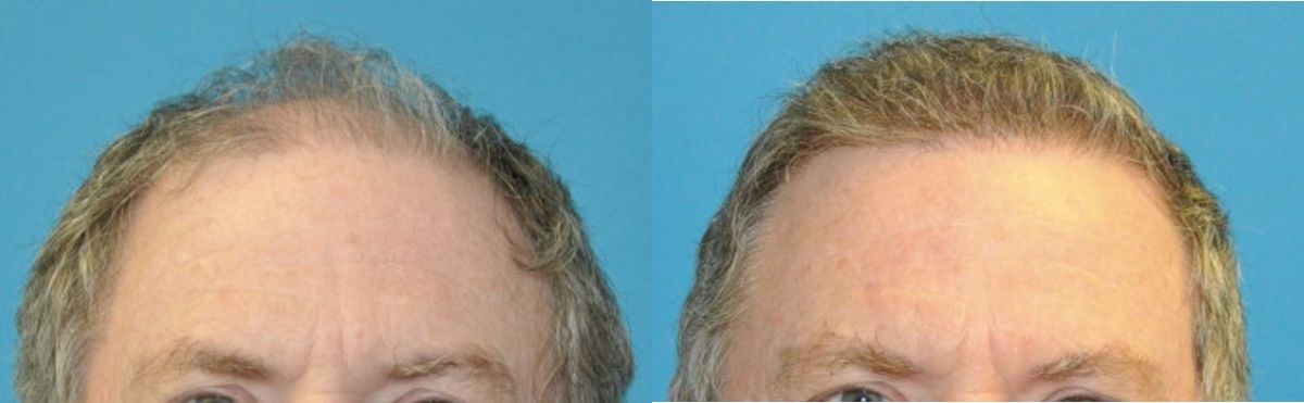 FUE NeoGraft Hair Transplant #14 - Before and After