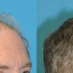 FUE NeoGraft Hair Transplant #14 - Before and After