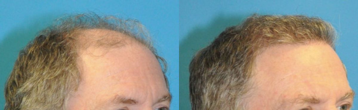 FUE NeoGraft Hair Transplant #14 - Before and After