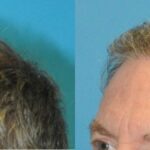FUE NeoGraft Hair Transplant #14 - Before and After