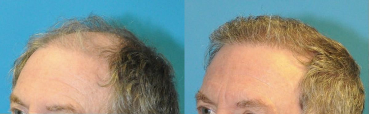 FUE NeoGraft Hair Transplant #14 - Before and After