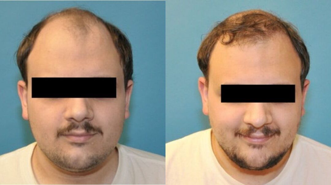 FUE NeoGraft Hair Transplant #5