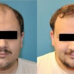 FUE NeoGraft Hair Transplant #5 - Before and After