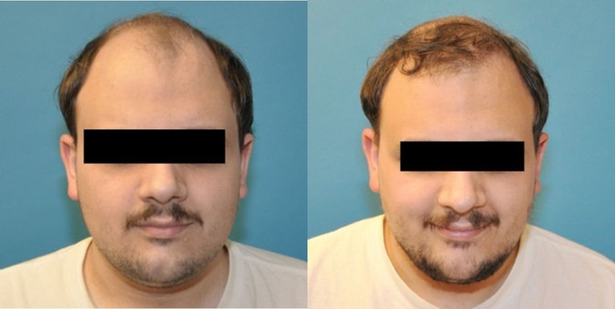 FUE NeoGraft Hair Transplant #5 - Before and After