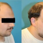 FUE NeoGraft Hair Transplant #5 - Before and After