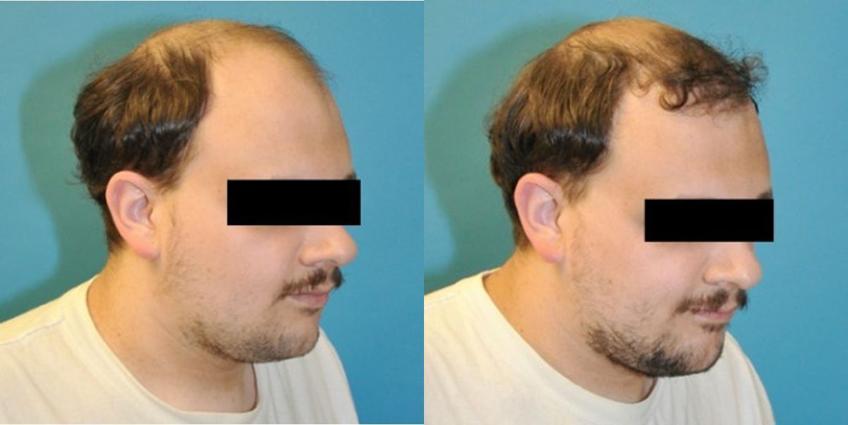 FUE NeoGraft Hair Transplant #5 - Before and After