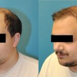 FUE NeoGraft Hair Transplant #5 - Before and After