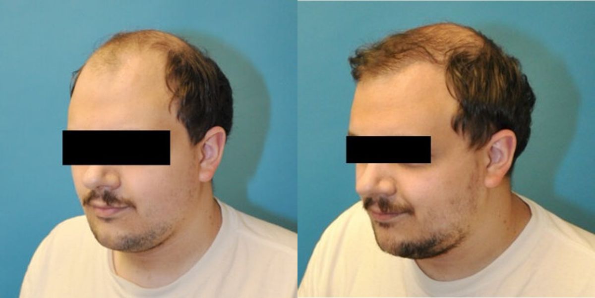 FUE NeoGraft Hair Transplant #5 - Before and After