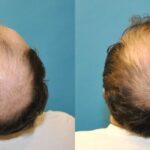 FUE NeoGraft Hair Transplant #5 - Before and After