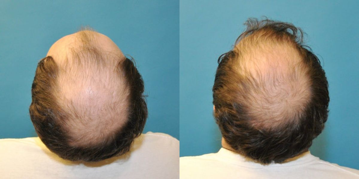 FUE NeoGraft Hair Transplant #5 - Before and After