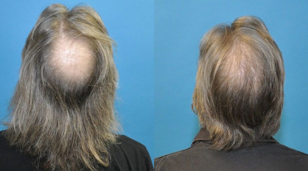 FUE NeoGraft Hair Transplant #6