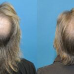 FUE NeoGraft Hair Transplant #6 - Before and After