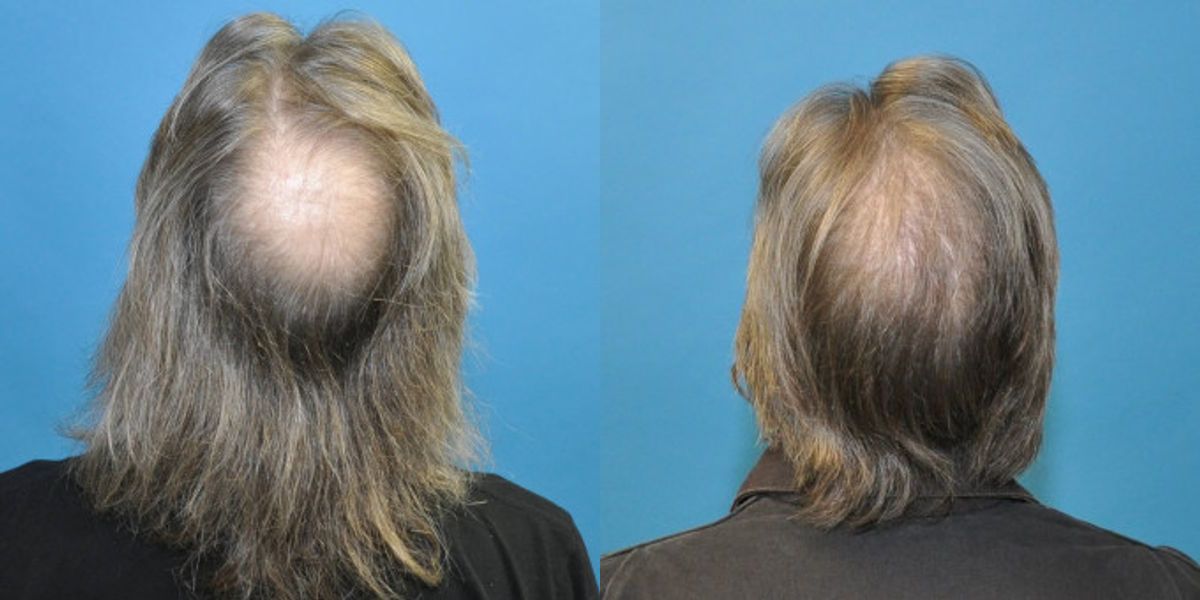FUE NeoGraft Hair Transplant #6 - Before and After