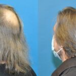 FUE NeoGraft Hair Transplant #6 - Before and After