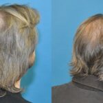 FUE NeoGraft Hair Transplant #6 - Before and After