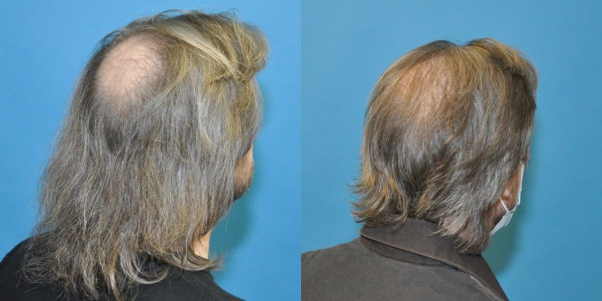 FUE NeoGraft Hair Transplant #6 - Before and After