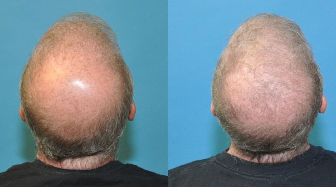 FUE NeoGraft Hair Transplant #7