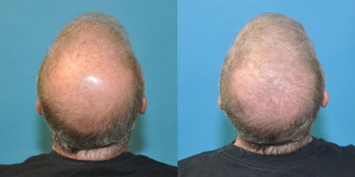 FUE NeoGraft Hair Transplant #7 - Before and After