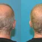 FUE NeoGraft Hair Transplant #7 - Before and After