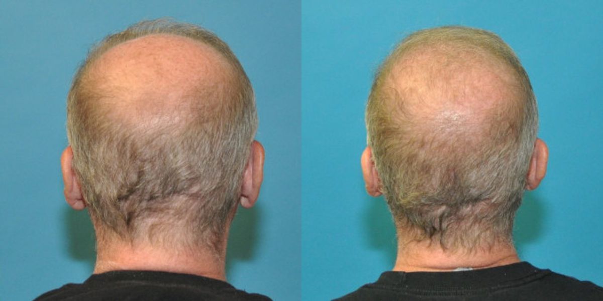 FUE NeoGraft Hair Transplant #7 - Before and After
