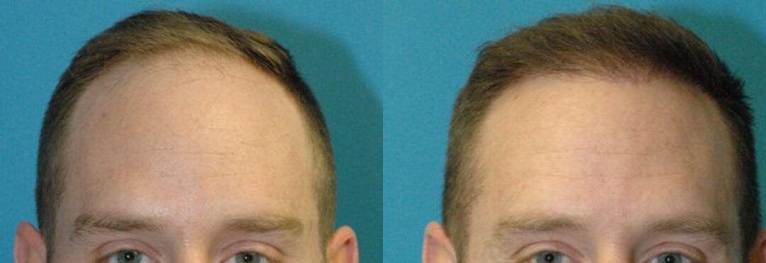 FUE NeoGraft Hair Transplant #8
